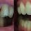 Ravnanje zob z nevidnim zobnim aparatom brez bolečin